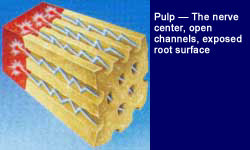 image of Pulp - the nerve center, open channels, exposed root surface